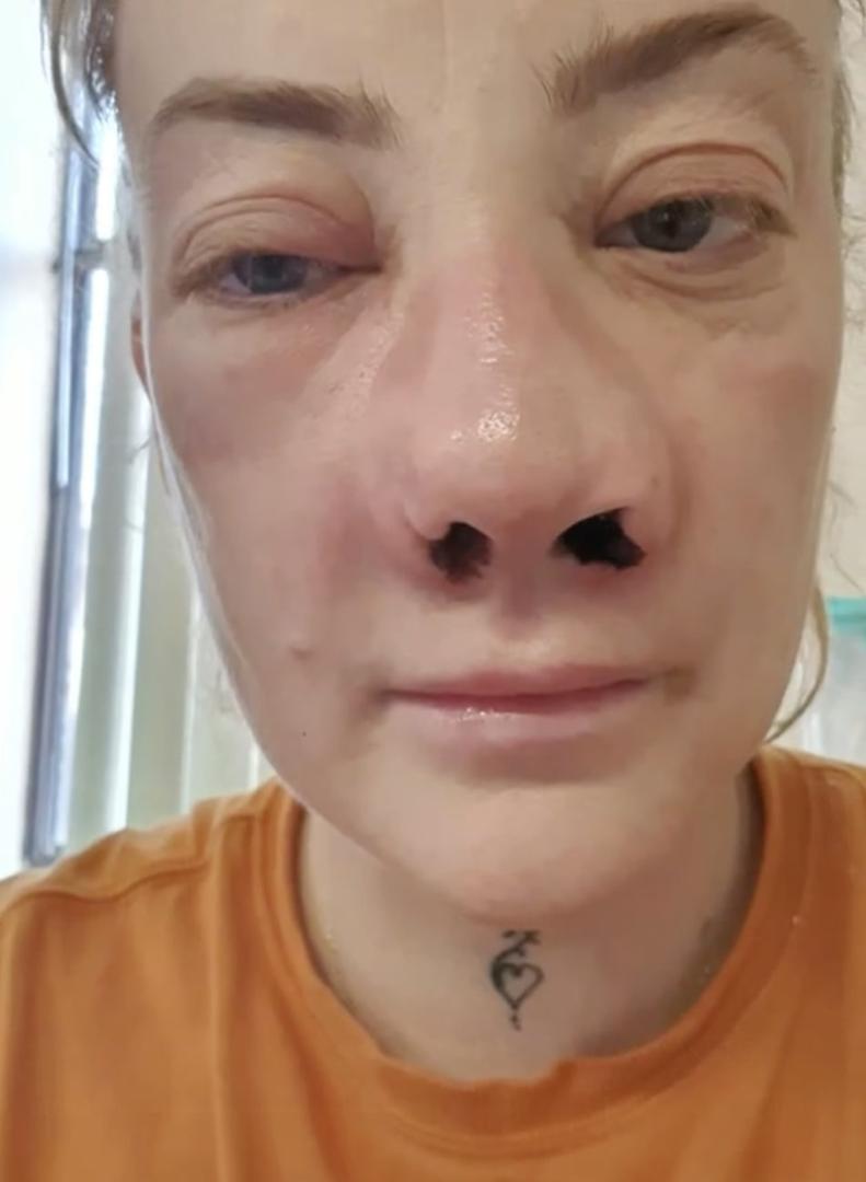 "Kada su mi dali prvu seriju injekcija i počeli vaditi zube, mogla sam sve osjetiti. Dobila sam oko 25 injekcija u šest sati. Podizanje sinusa bilo je kao da su mi nešto zabijali u nos. Bilo je to kao horor film tijekom kojeg sam bila potpuno budna", ispričala je. Rekla je kako su je pokupili nakon operacije i odveli u lijepi hotel, gdje su bili i njihovi drugi klijenti. 